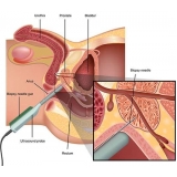 biopsias-de-prostatas-avaliacao-urodinamica-biopsia-de-prostata-em-sao-paulo-preco-em-belem