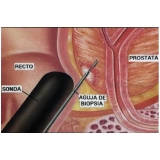 biopsias-de-prostatas-avaliacao-urodinamica-biopsia-de-prostata-em-sp-na-ponte-rasa