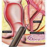 cirurgias-de-postectomia-cirurgia-de-fimose-postectomia-cirurgia-de-postectomia-laser-agua-rasa