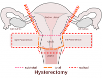 vasectomia